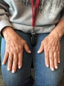 Laser treatment Hands before after